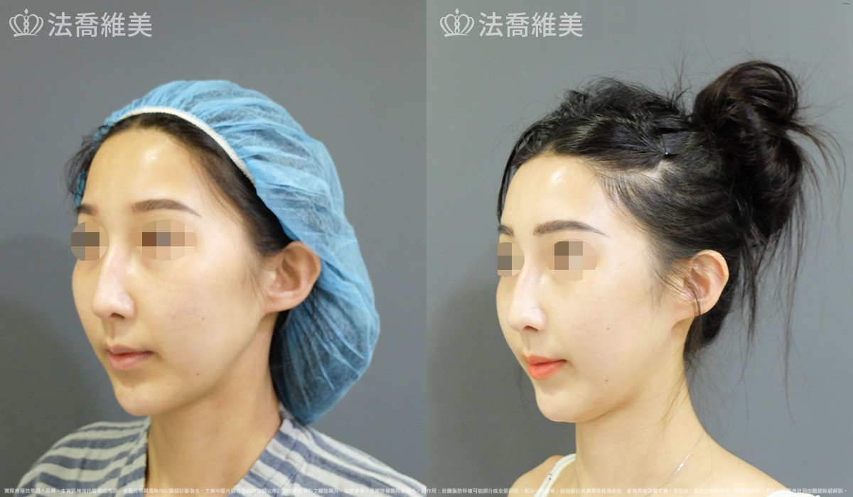 法喬醫美診所,邱浚彥,自體豐全臉