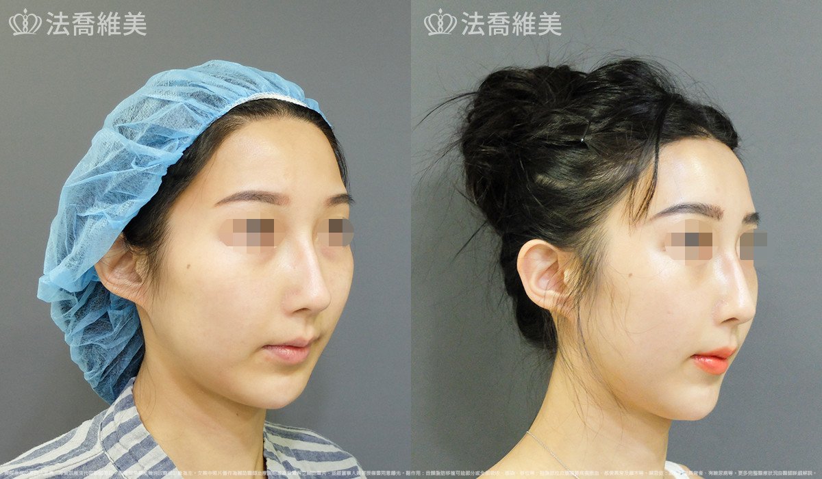 法喬醫美診所,邱浚彥,自體豐全臉