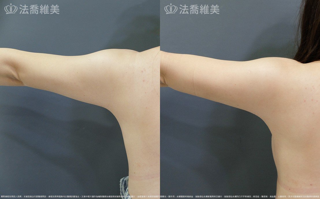 法喬醫美診所,邱浚彥,威塑蝴蝶袖