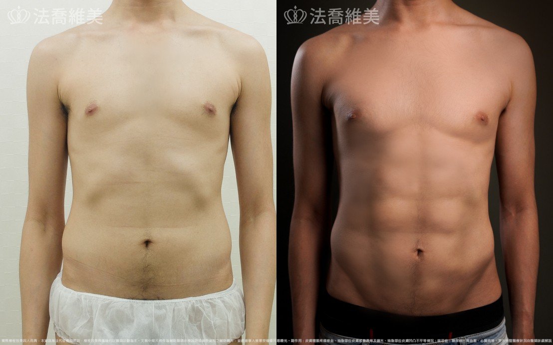 法喬醫美診所邱浚彥醫師威塑抽脂體雕