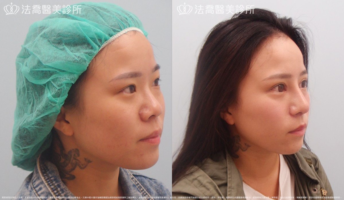 法喬醫美診所,邱浚彥,自體肋骨隆鼻