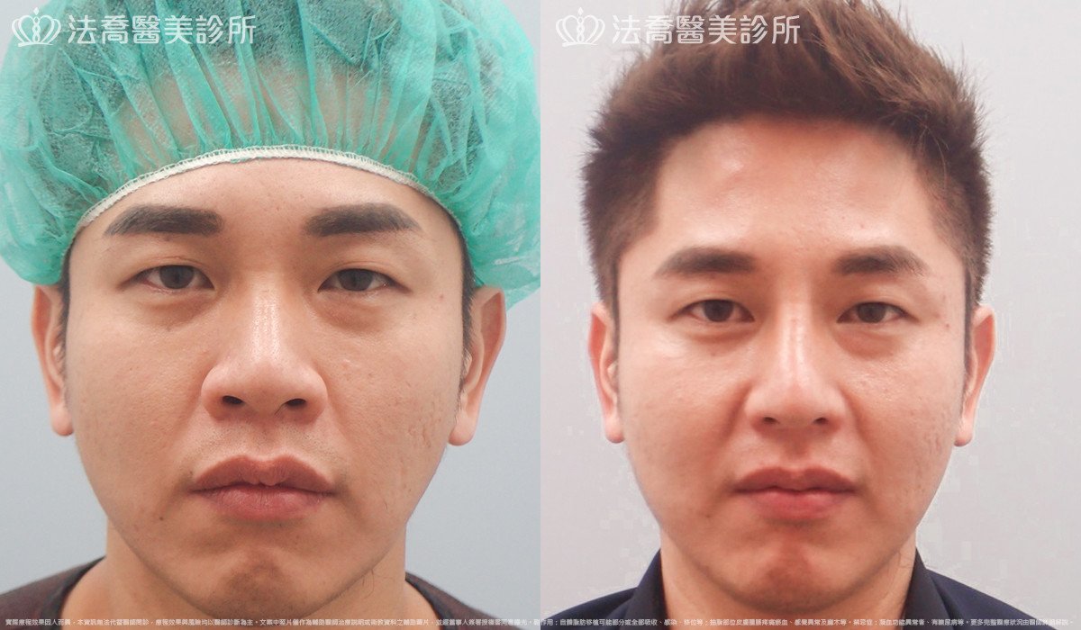 法喬醫美診所,邱浚彥,自體肋骨隆鼻