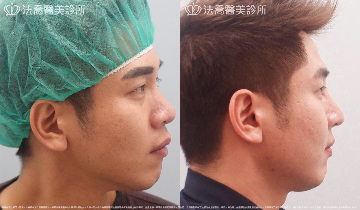 法喬醫美診所,邱浚彥,自體肋骨隆鼻