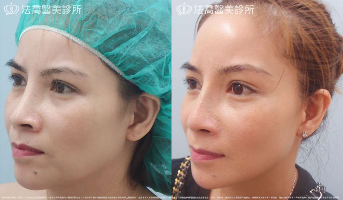 法喬醫美診所,邱浚彥,自體肋骨隆鼻,鼻截骨,縮鼻翼