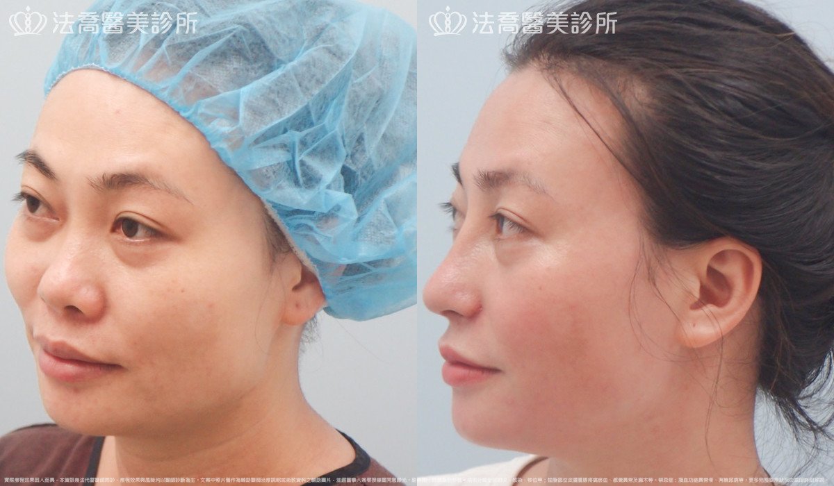 法喬醫美診所,邱浚彥,自體肋骨隆鼻