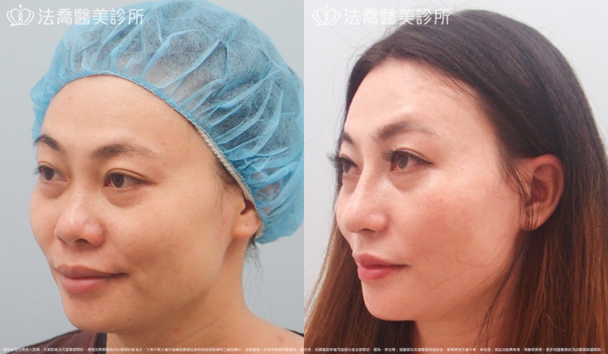 法喬醫美診所,邱浚彥,自體肋骨隆鼻