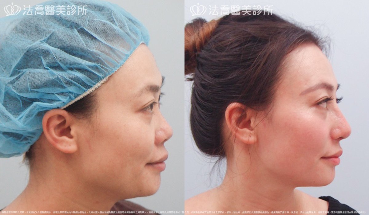 法喬醫美診所,邱浚彥,自體肋骨隆鼻