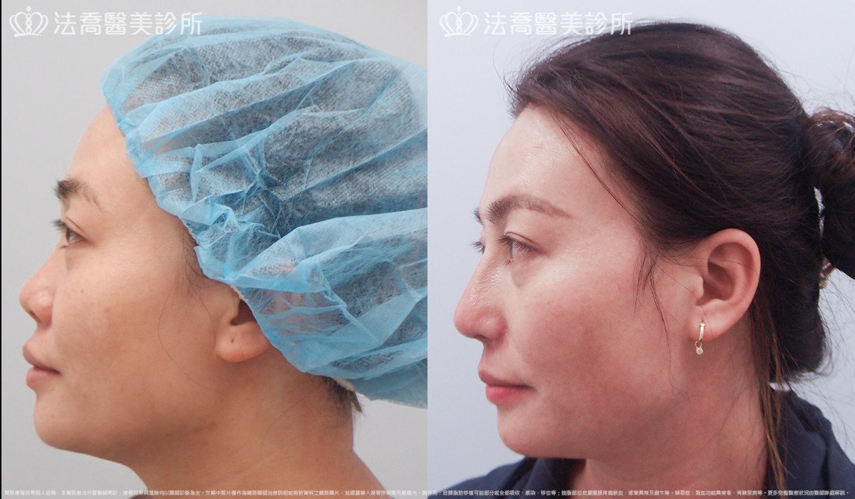 法喬醫美診所,邱浚彥,自體肋骨隆鼻
