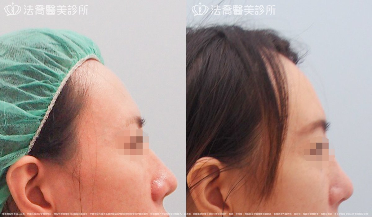 法喬醫美診所,邱浚彥,自體肋骨隆鼻