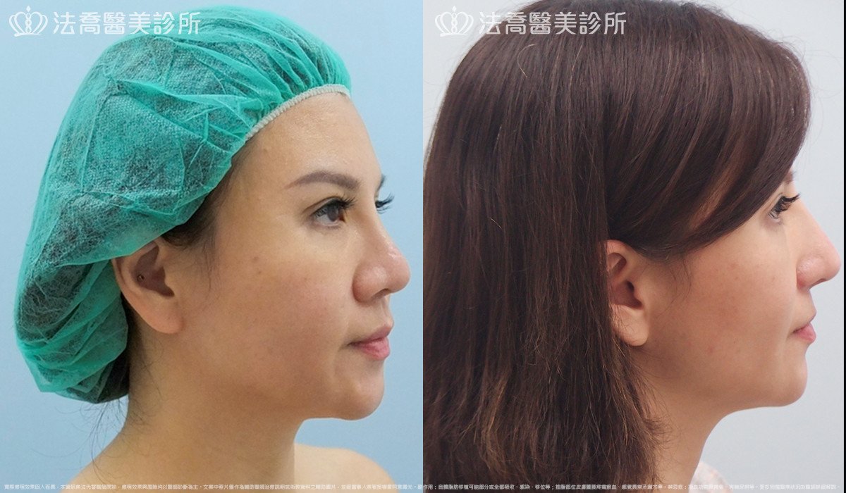 法喬醫美診所,邱浚彥,自體肋骨隆鼻