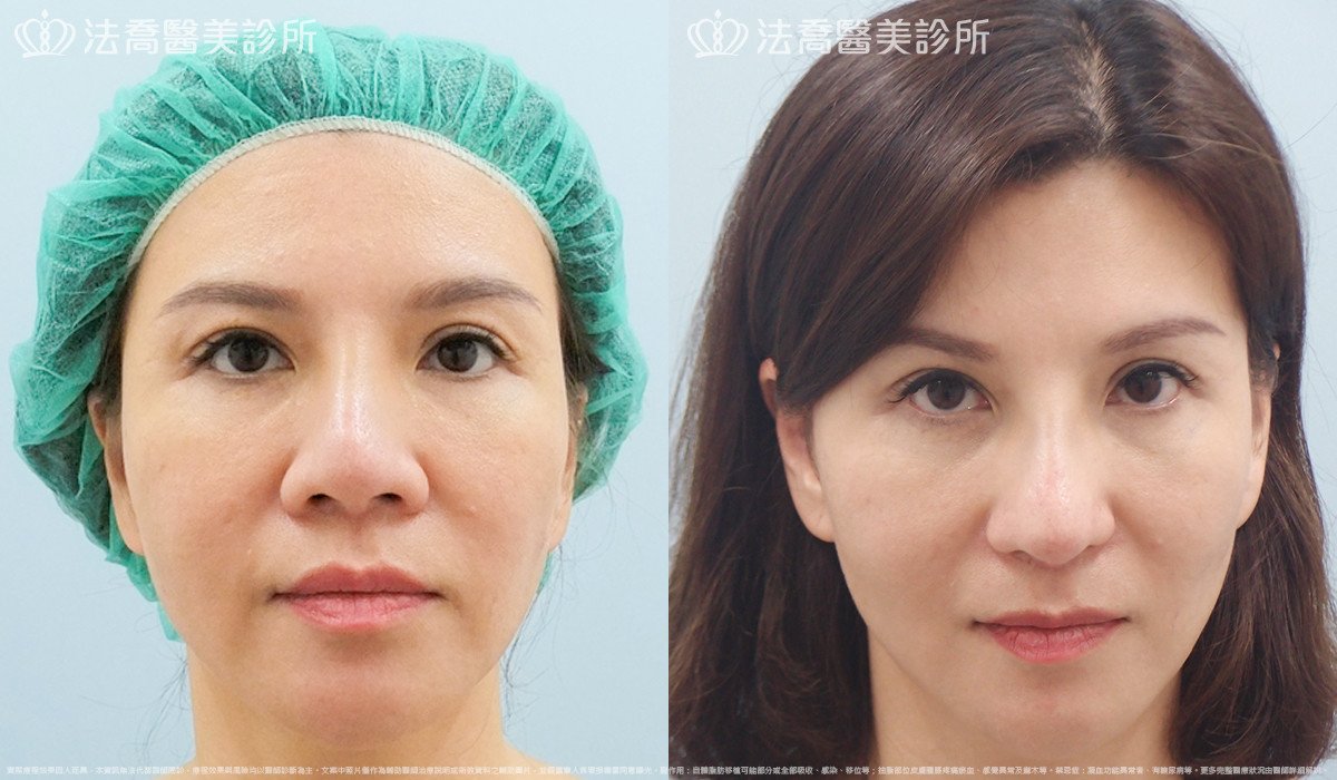 法喬醫美診所,邱浚彥,自體肋骨隆鼻