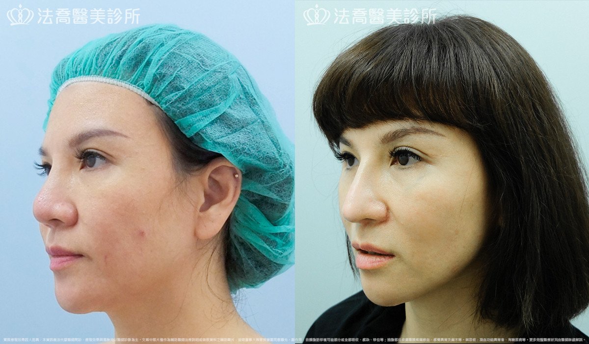 法喬醫美診所,邱浚彥,自體肋骨隆鼻