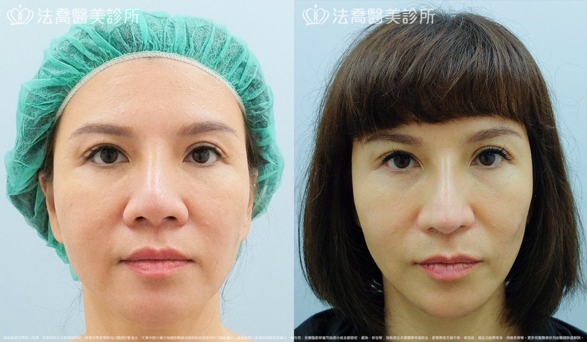 法喬醫美診所,邱浚彥,自體肋骨隆鼻