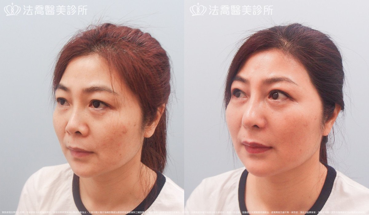 法喬醫美診所,邱浚彥,自體肋骨隆鼻