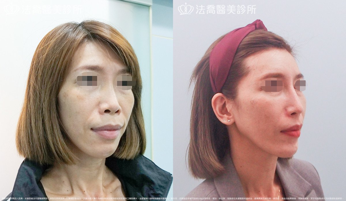 法喬醫美診所,邱浚彥,人工骨墊下巴