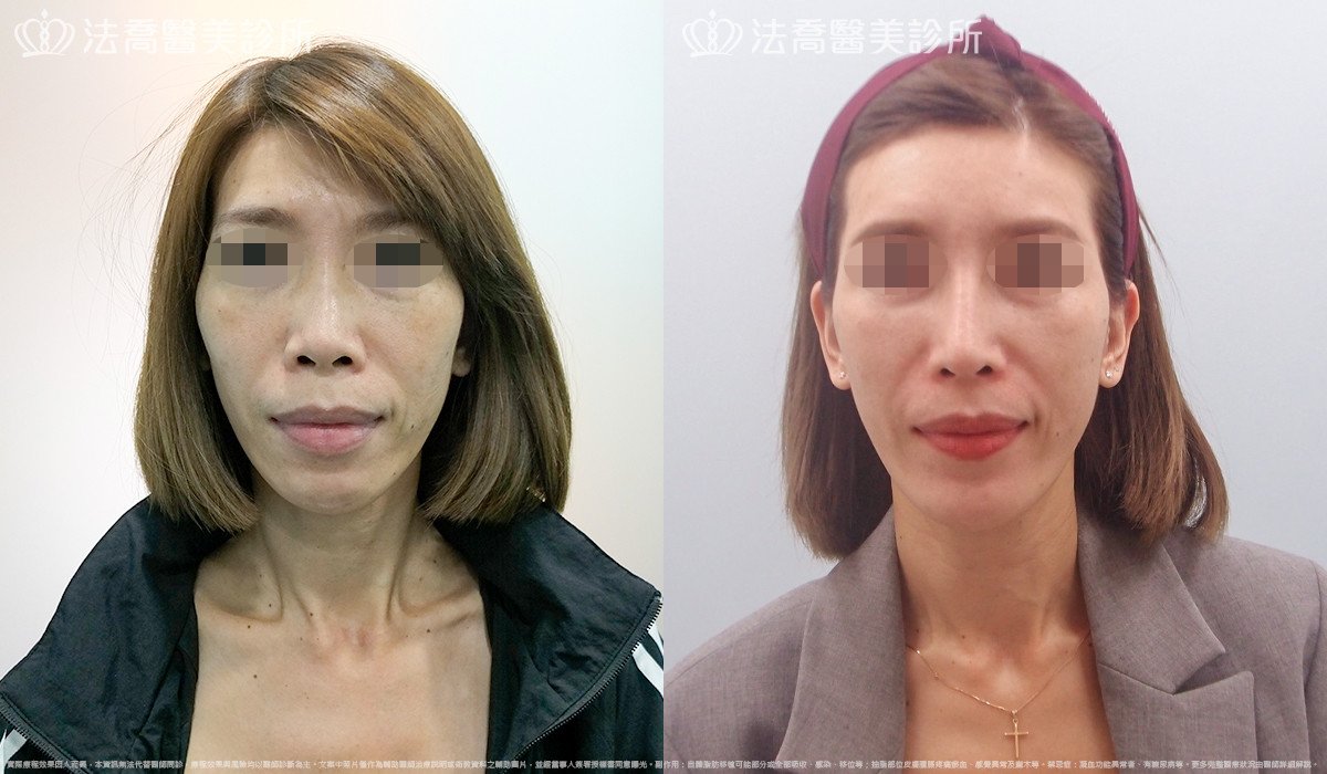 法喬醫美診所,邱浚彥,人工骨墊下巴