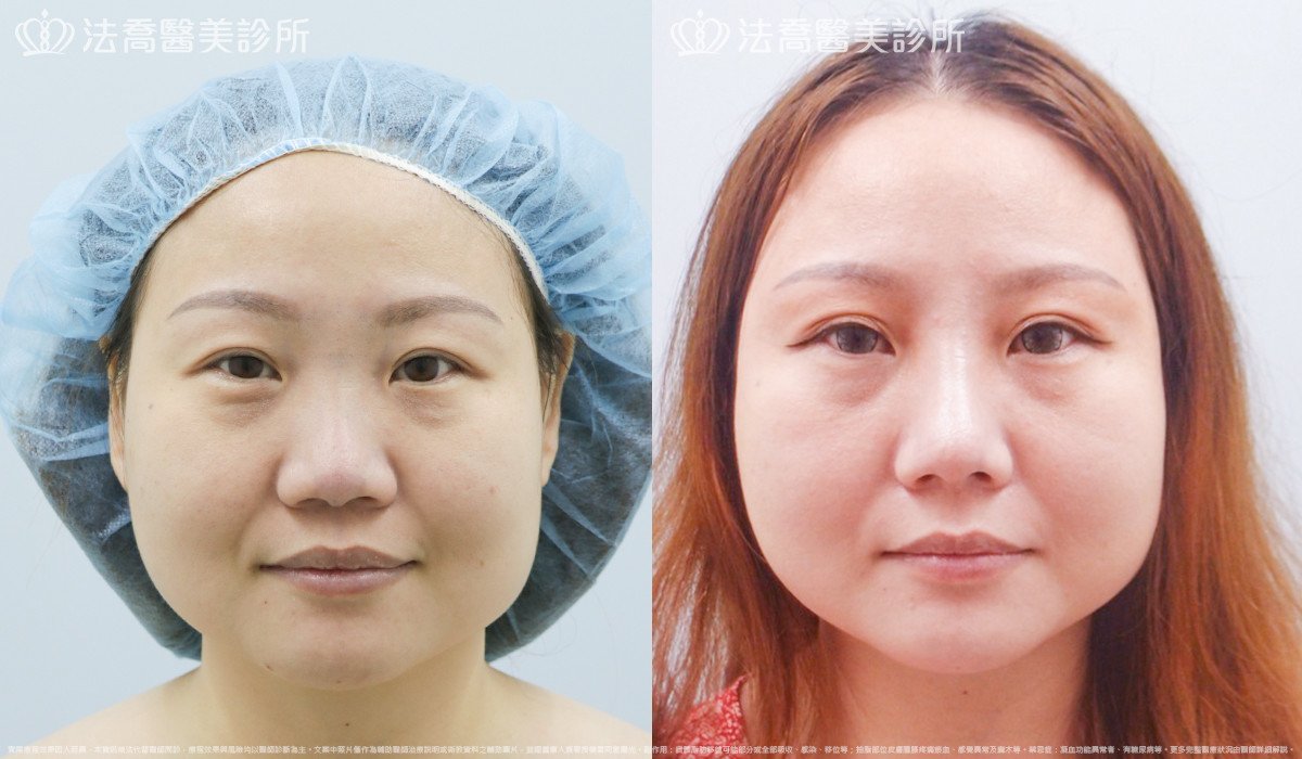 法喬醫美診所,邱浚彥,自體肋骨隆鼻