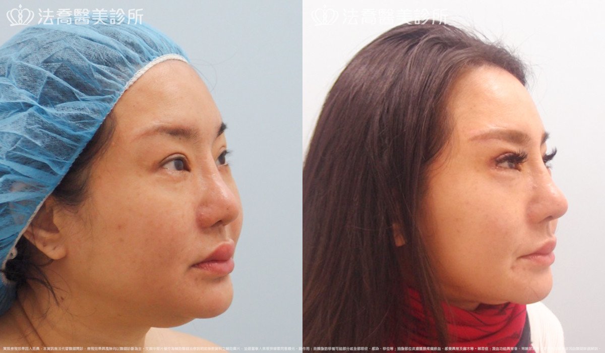 法喬醫美診所,邱浚彥,自體肋骨隆鼻