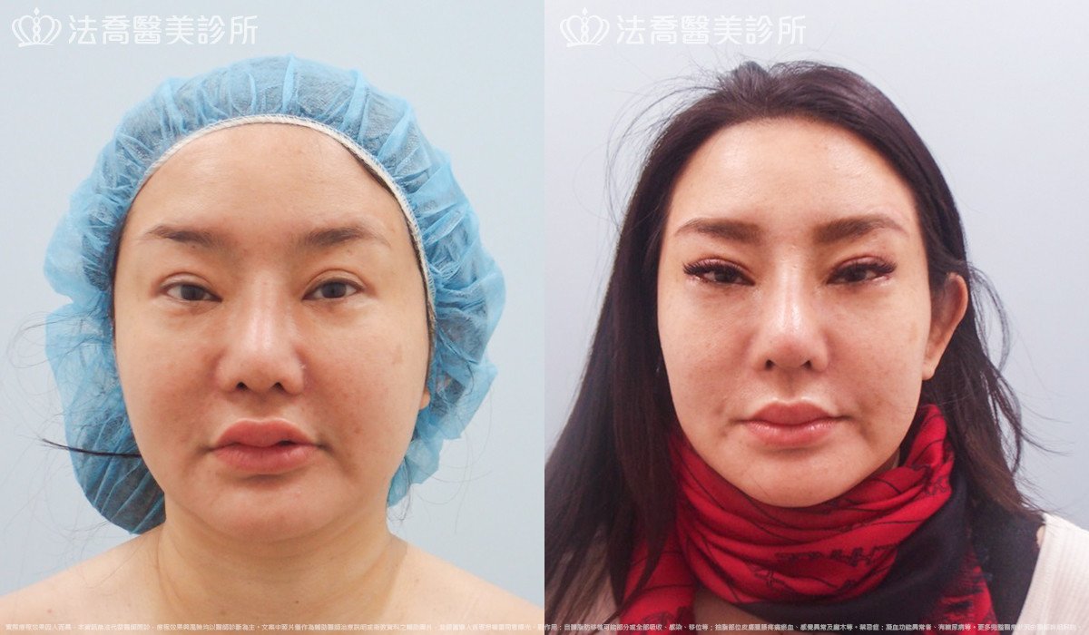 法喬醫美診所,邱浚彥,自體肋骨隆鼻