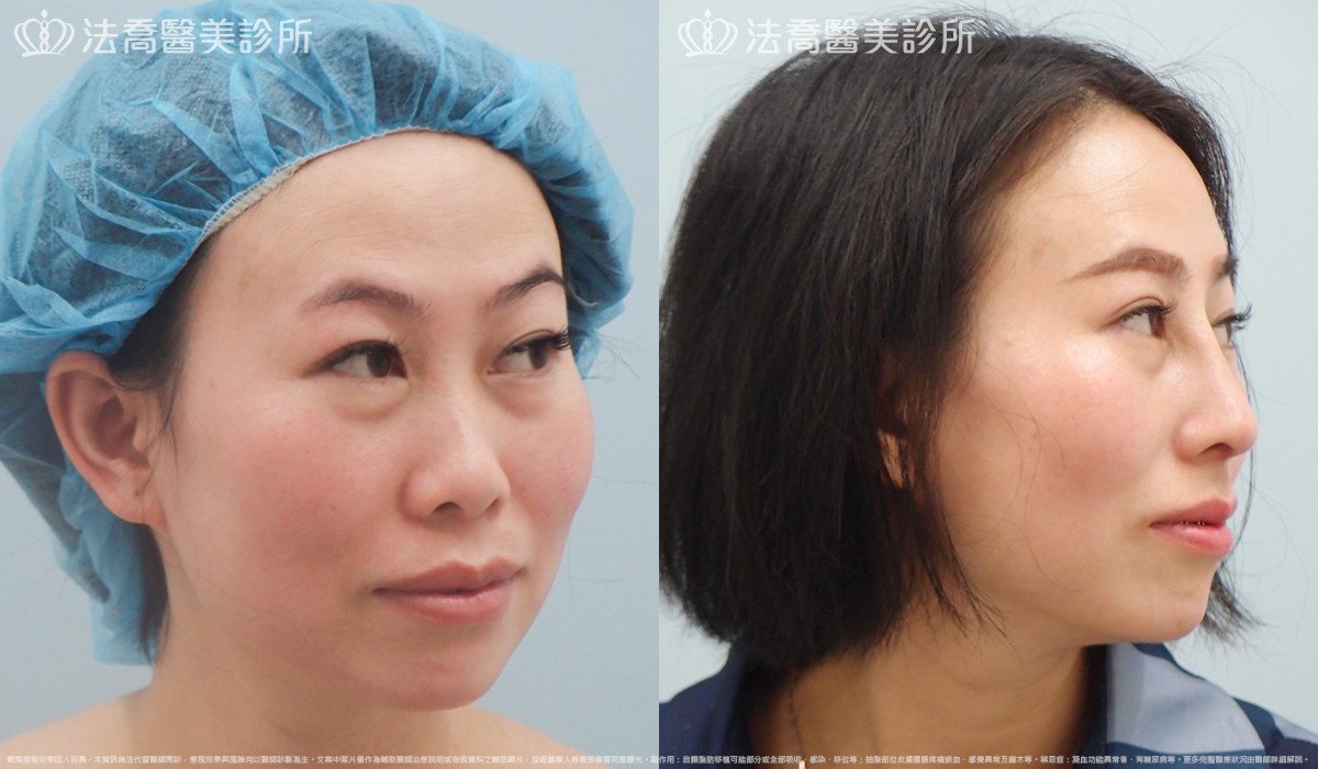 法喬醫美診所,邱浚彥,自體肋骨隆鼻