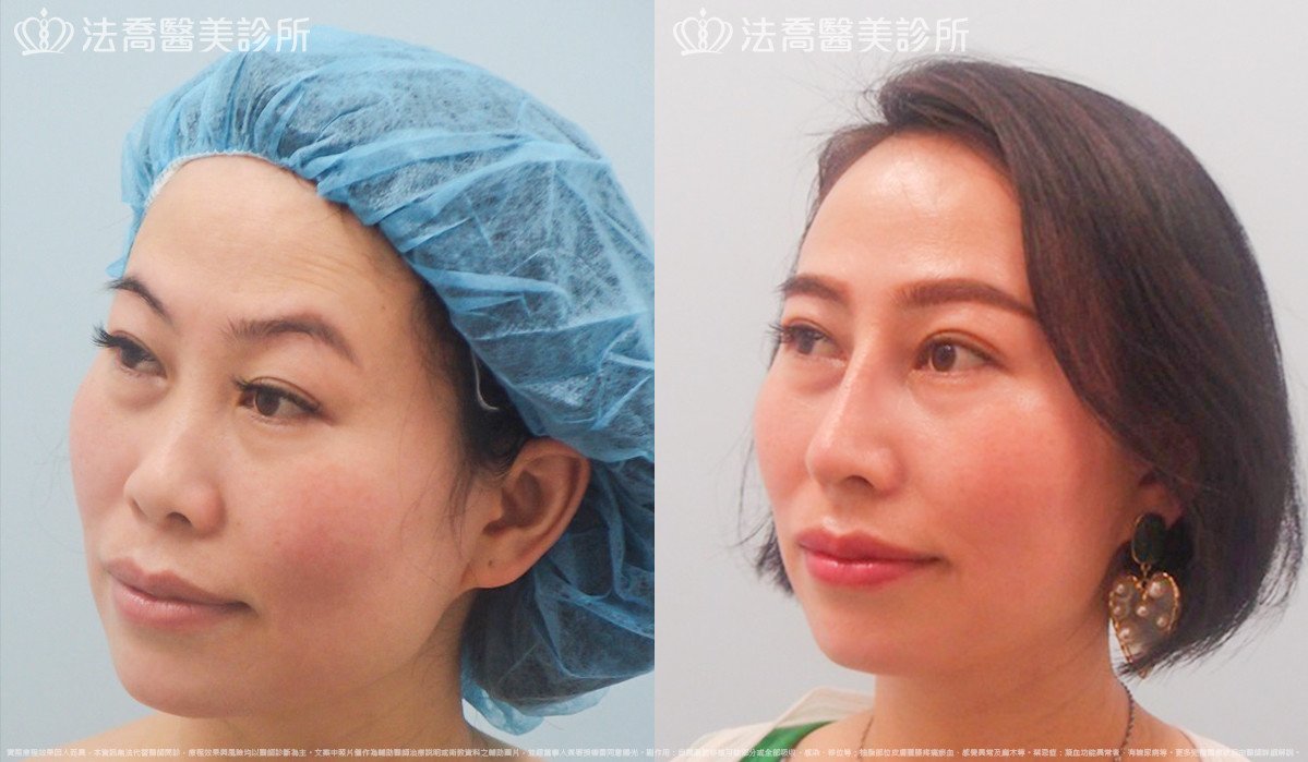 法喬醫美診所,邱浚彥,自體肋骨隆鼻