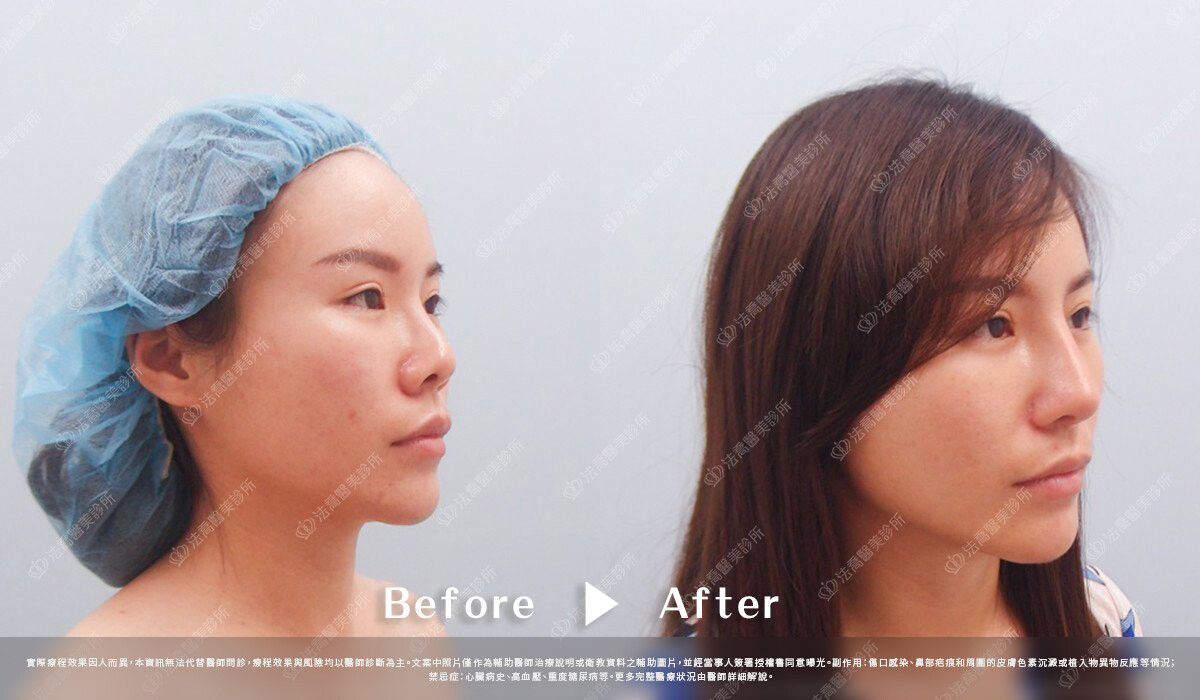 法喬醫美診所,邱浚彥,自體肋骨隆鼻