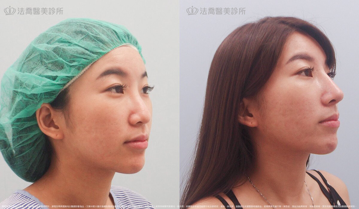 自體肋骨隆鼻,法喬醫美診所,邱浚彥