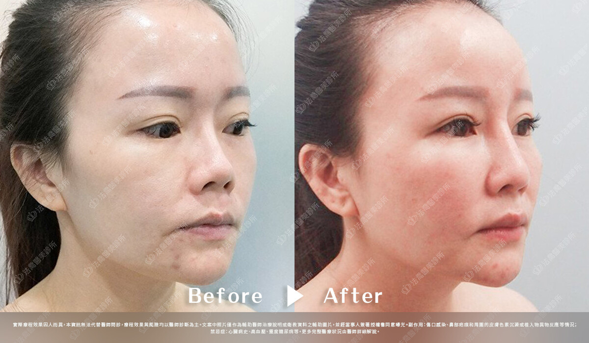 法喬醫美診所,邱浚彥,自體肋骨隆鼻