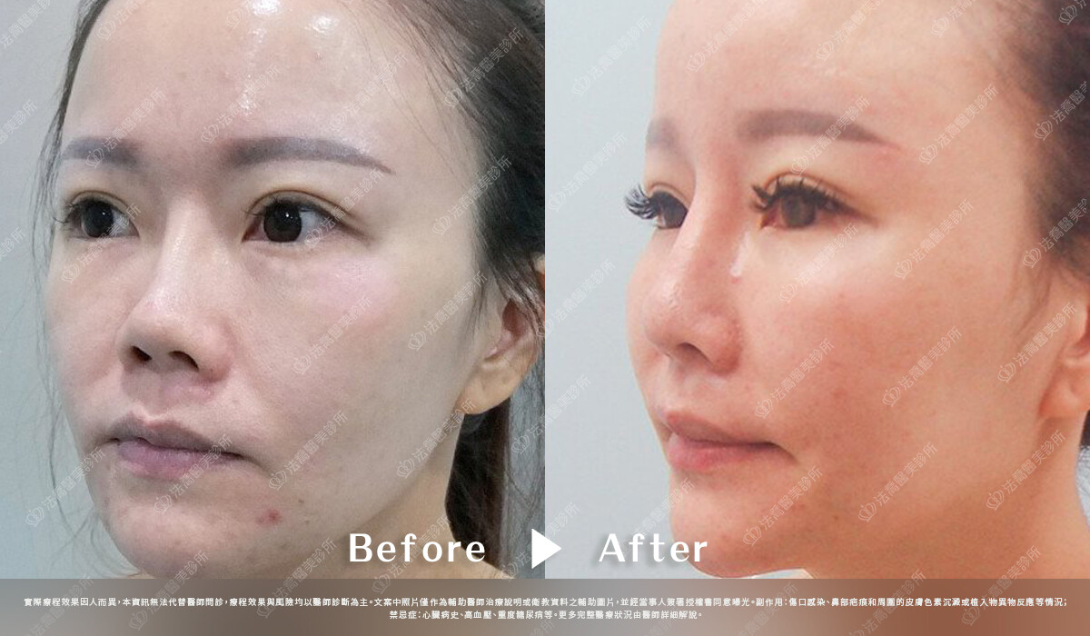 法喬醫美診所,邱浚彥,自體肋骨隆鼻