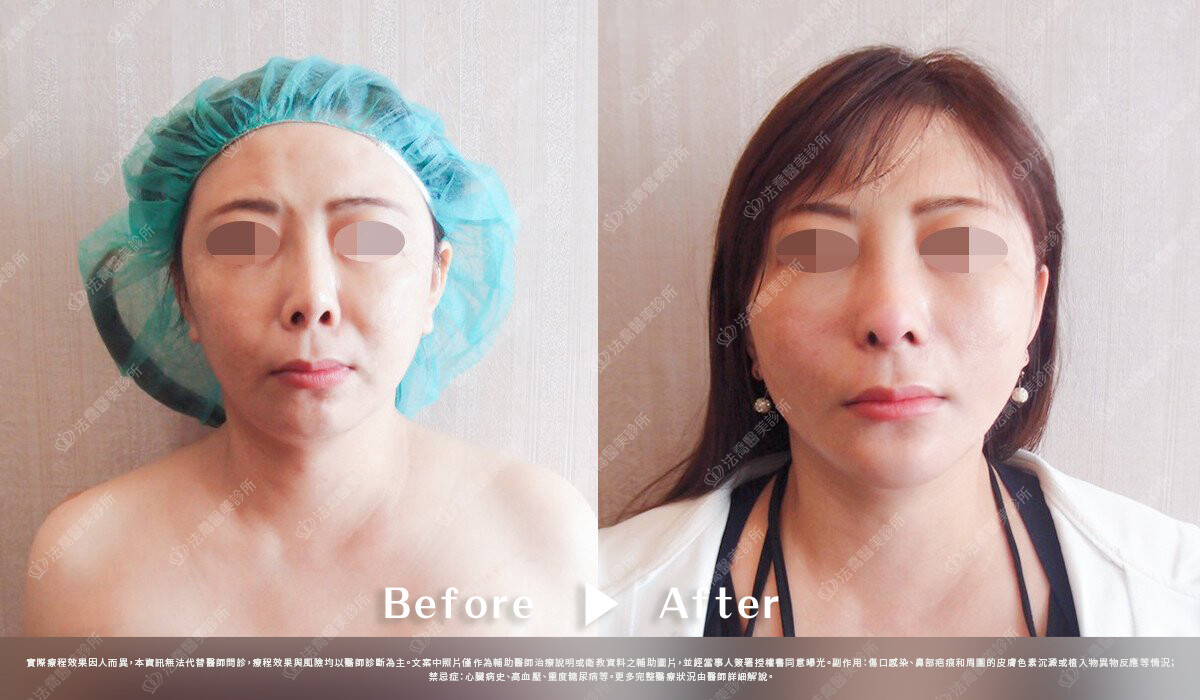 法喬醫美診所,邱浚彥,自體肋骨隆鼻