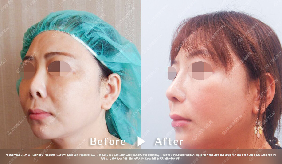 法喬醫美診所,邱浚彥,自體肋骨隆鼻