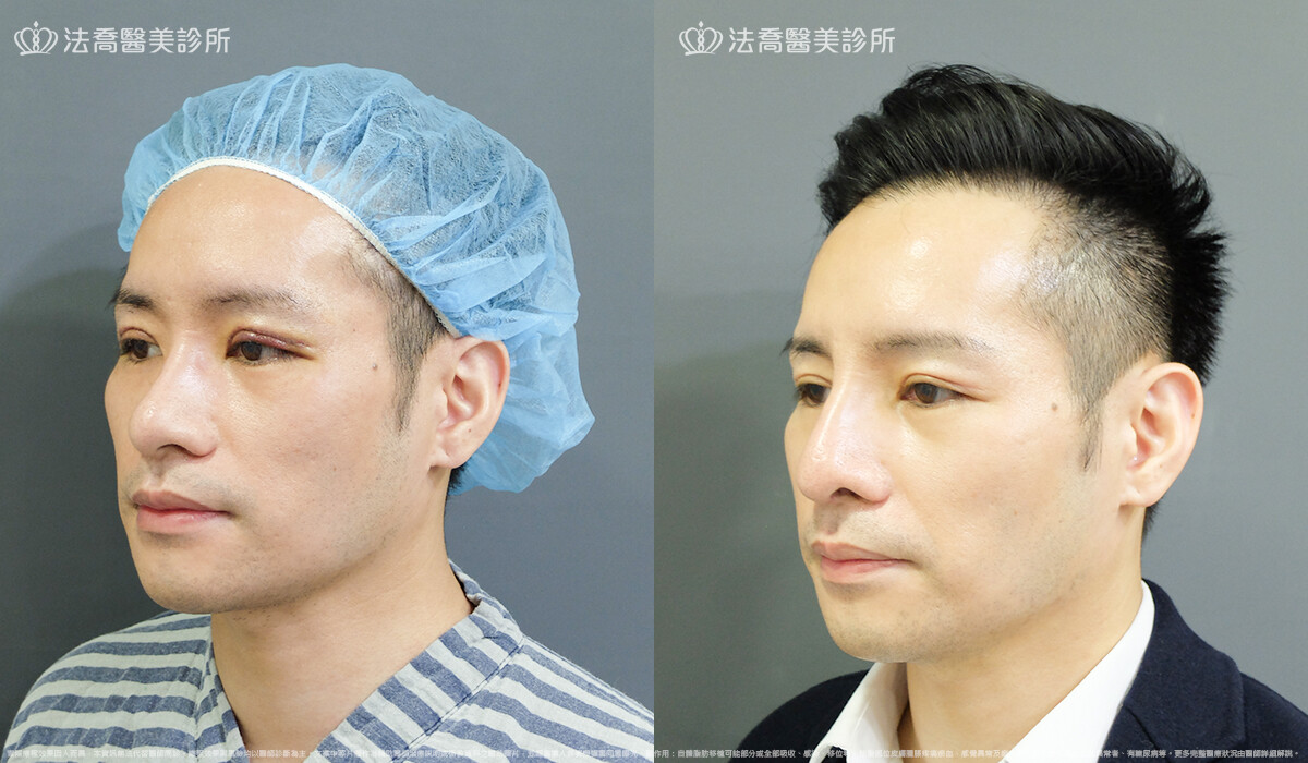 自體肋骨隆鼻,法喬醫美診所,邱浚彥