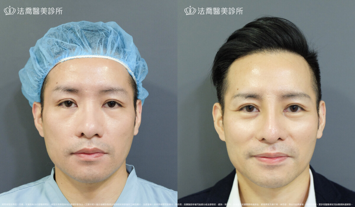 自體肋骨隆鼻,法喬醫美診所,邱浚彥