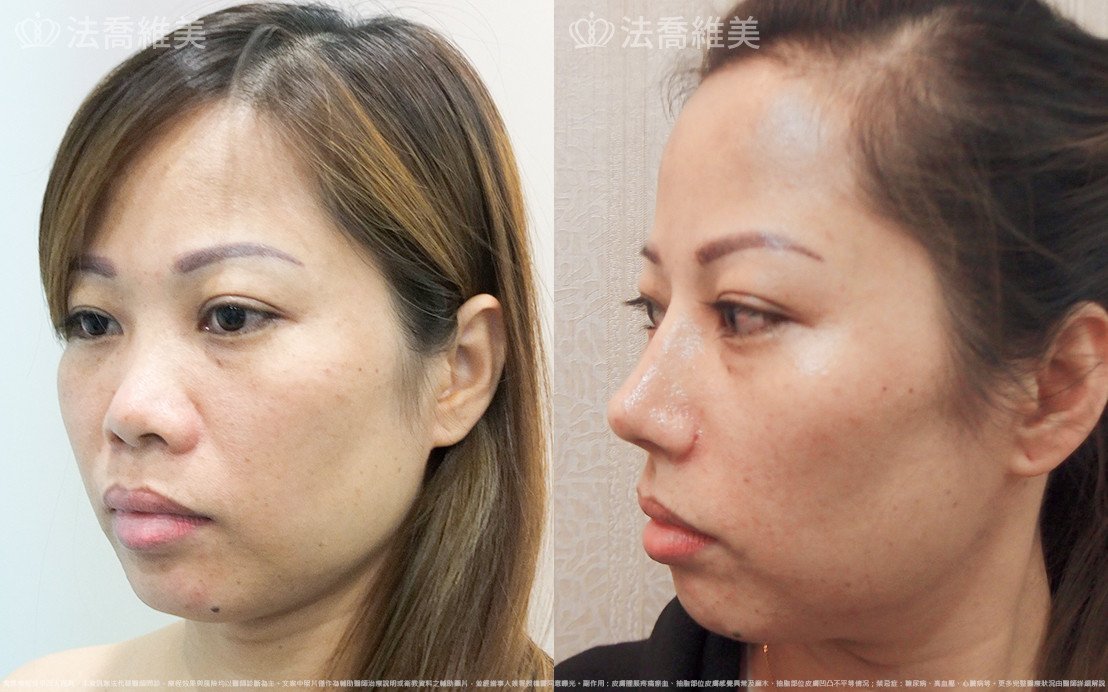法喬醫美診所,邱浚彥,自體肋骨隆鼻