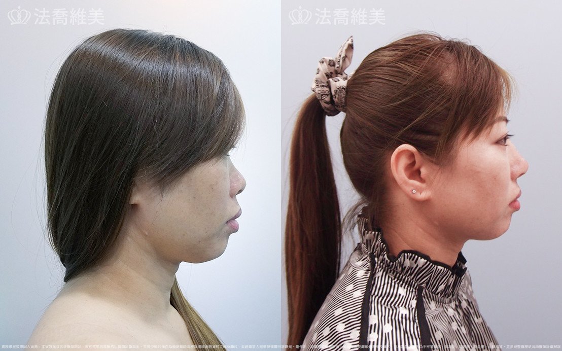 法喬醫美診所,邱浚彥,自體肋骨隆鼻