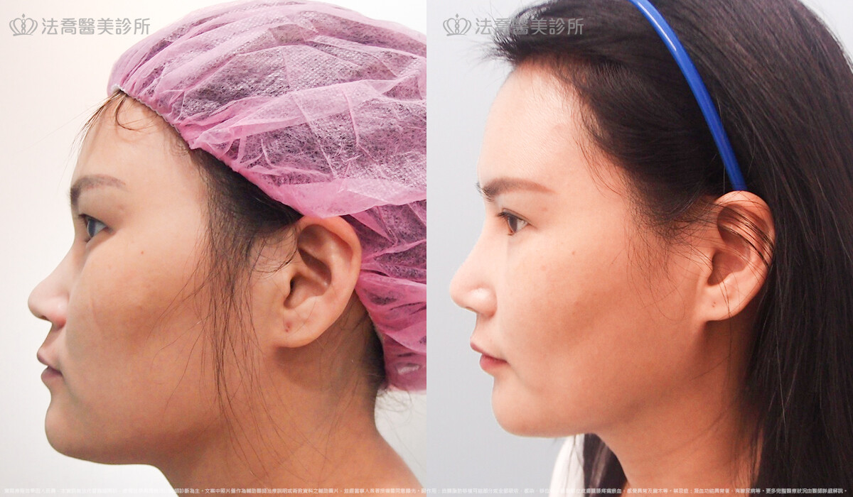 自體肋骨隆鼻,法喬醫美診所,邱浚彥