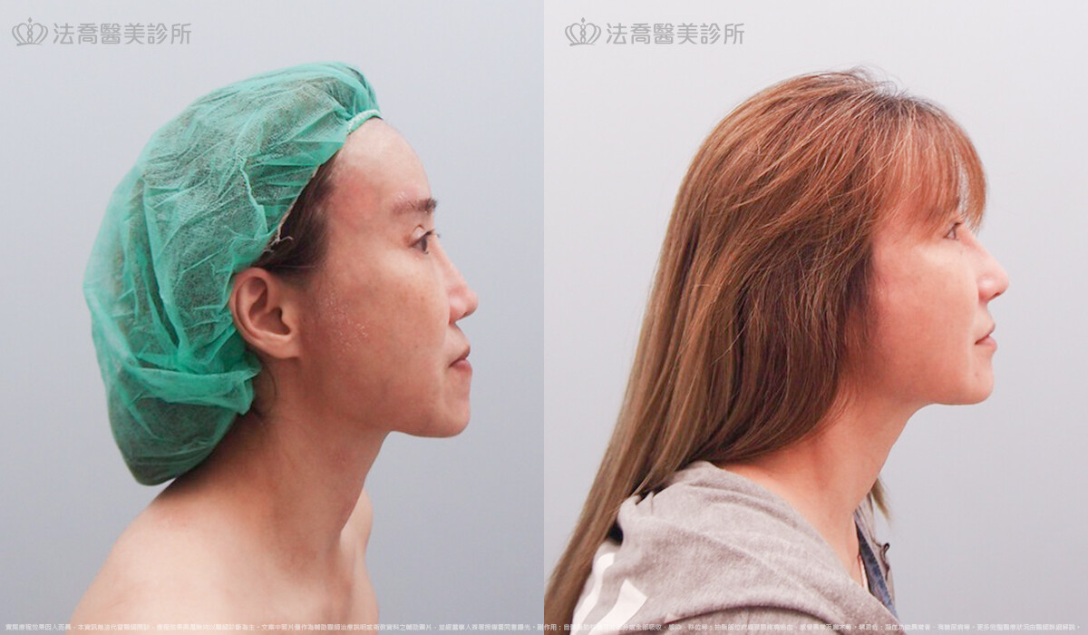 自體肋骨隆鼻,法喬醫美診所,邱浚彥