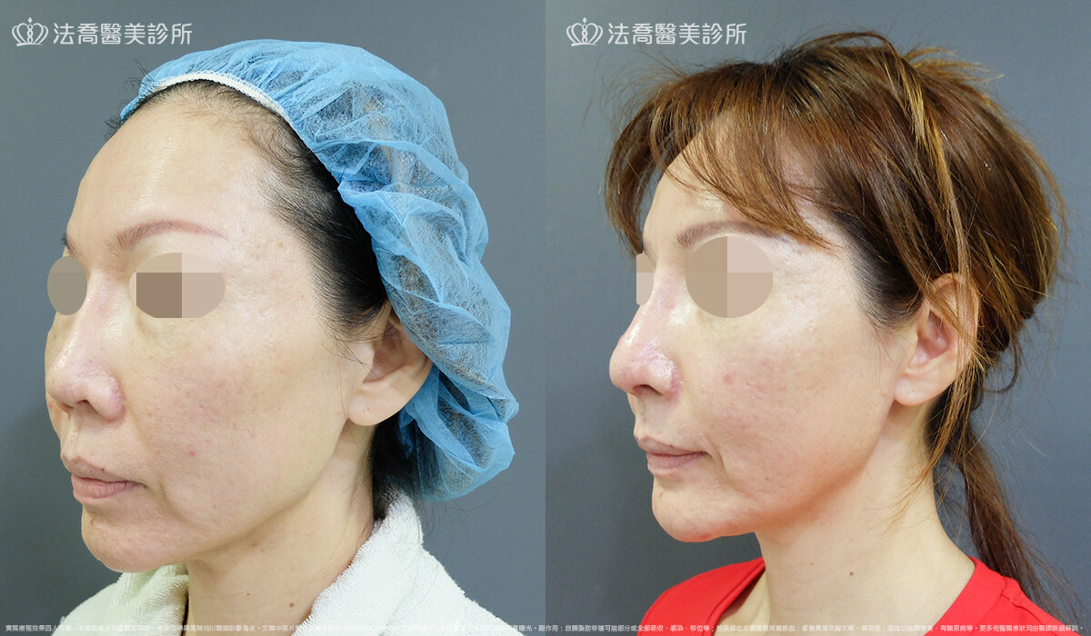 自體肋骨隆鼻,法喬醫美診所,邱浚彥