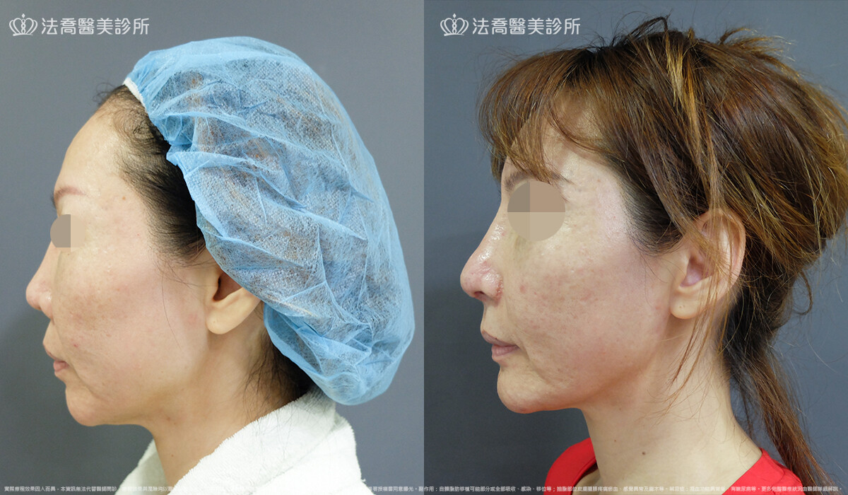 自體肋骨隆鼻,法喬醫美診所,邱浚彥