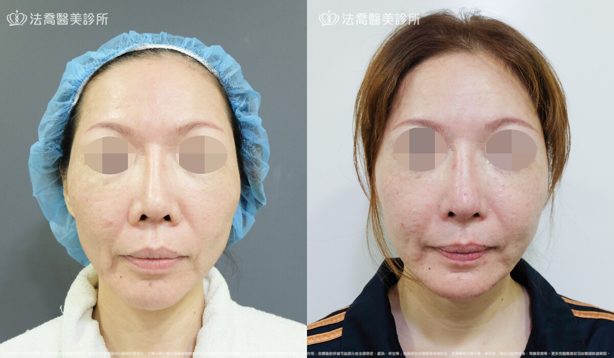 自體肋骨隆鼻,法喬醫美診所,邱浚彥