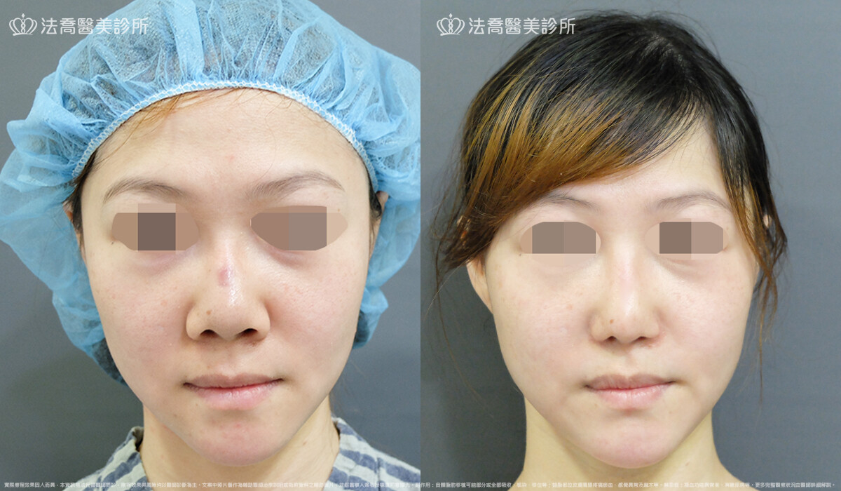 自體肋骨隆鼻,法喬醫美診所,邱浚彥