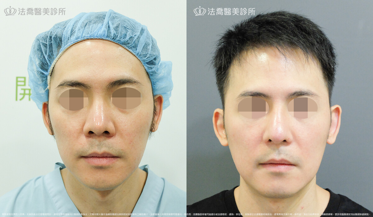 法喬醫美診所,邱浚彥,自體肋骨隆鼻