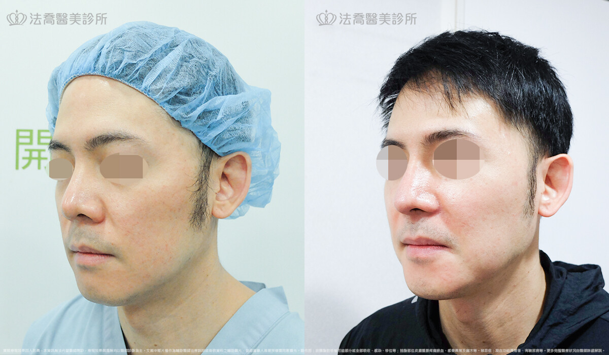 法喬醫美診所,邱浚彥,自體肋骨隆鼻