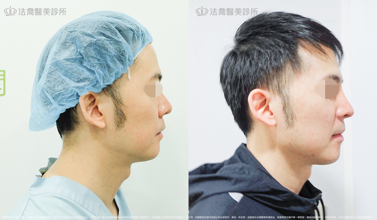 法喬醫美診所,邱浚彥,自體肋骨隆鼻