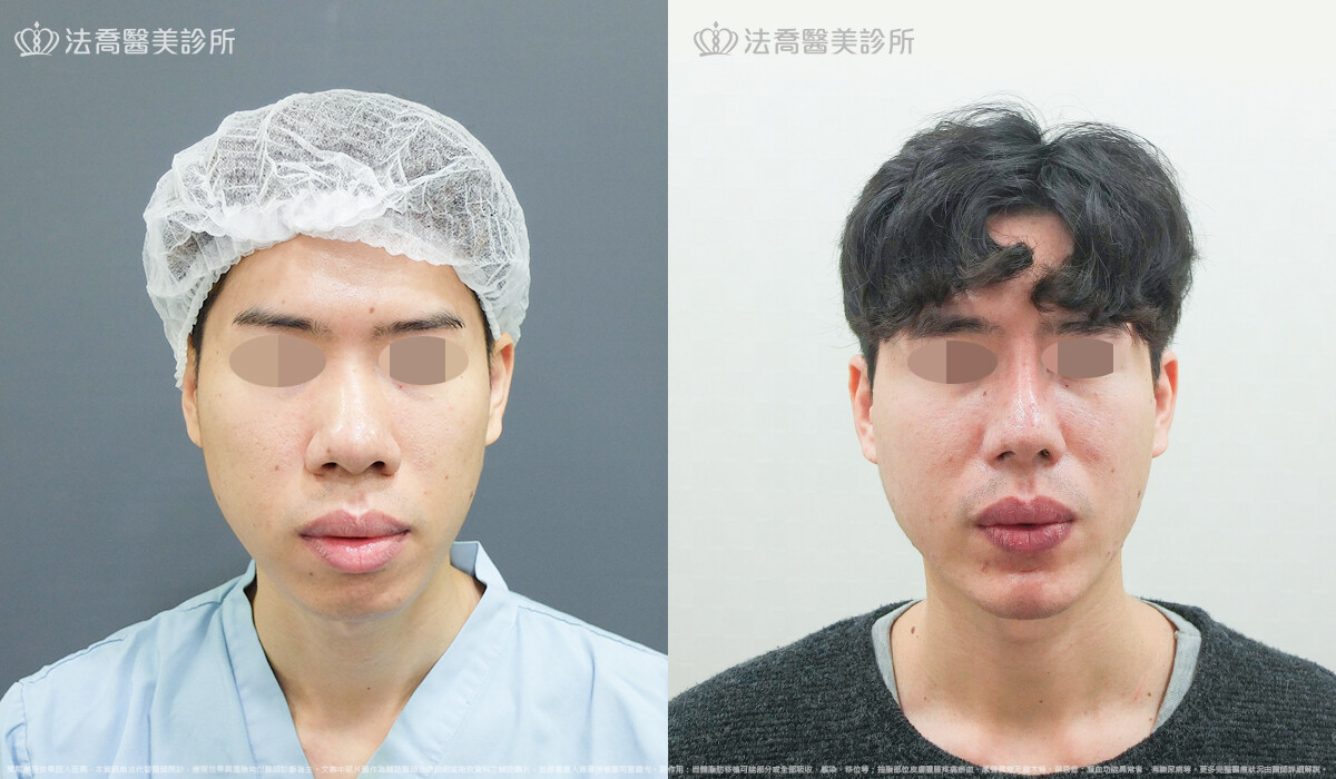 法喬醫美診所,邱浚彥,自體肋骨隆鼻