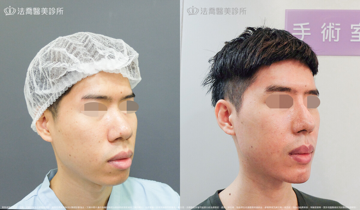 法喬醫美診所,邱浚彥,自體肋骨隆鼻