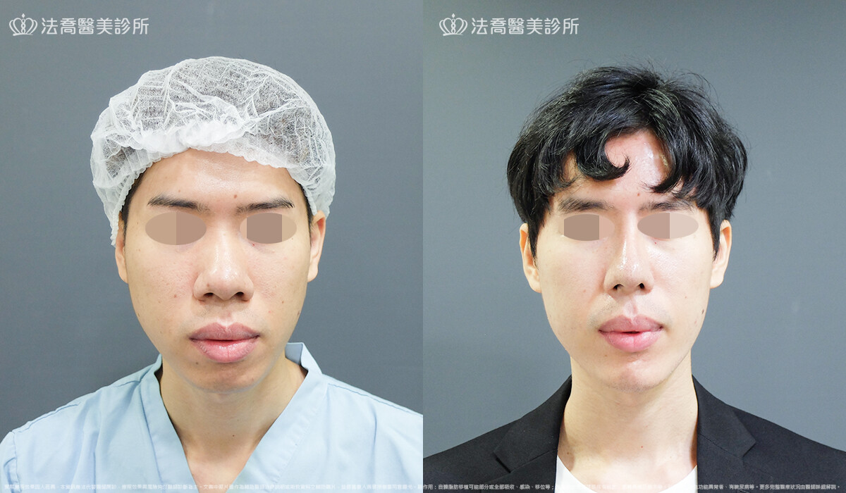 法喬醫美診所,邱浚彥,自體肋骨隆鼻