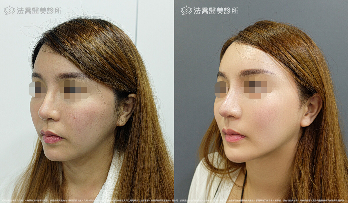 卡麥拉取出 / 自體肋骨隆鼻 / 人工骨墊下巴