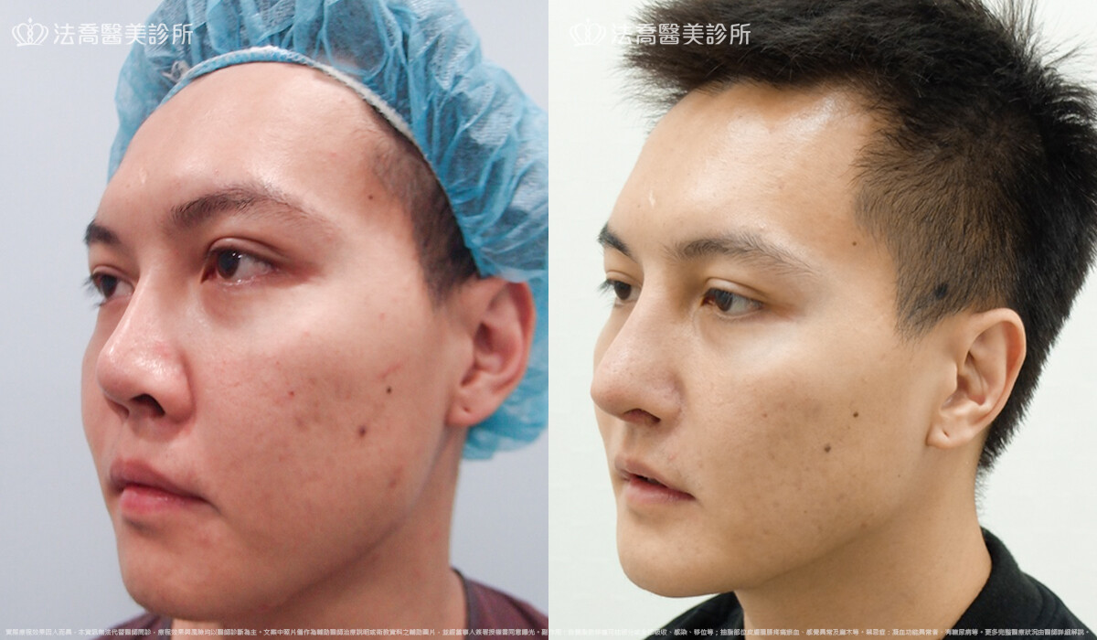 goretex隆鼻,法喬醫美診所,邱浚彥