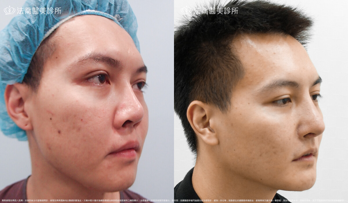 goretex隆鼻,法喬醫美診所,邱浚彥